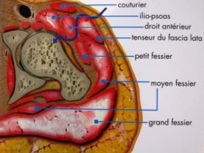 Les voies d’abord pour prothèse totale de hanche